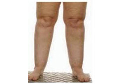 Lipoedema